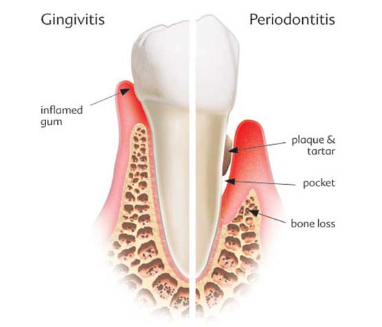 seoulinplant periodontal disease tooth loss mechanism