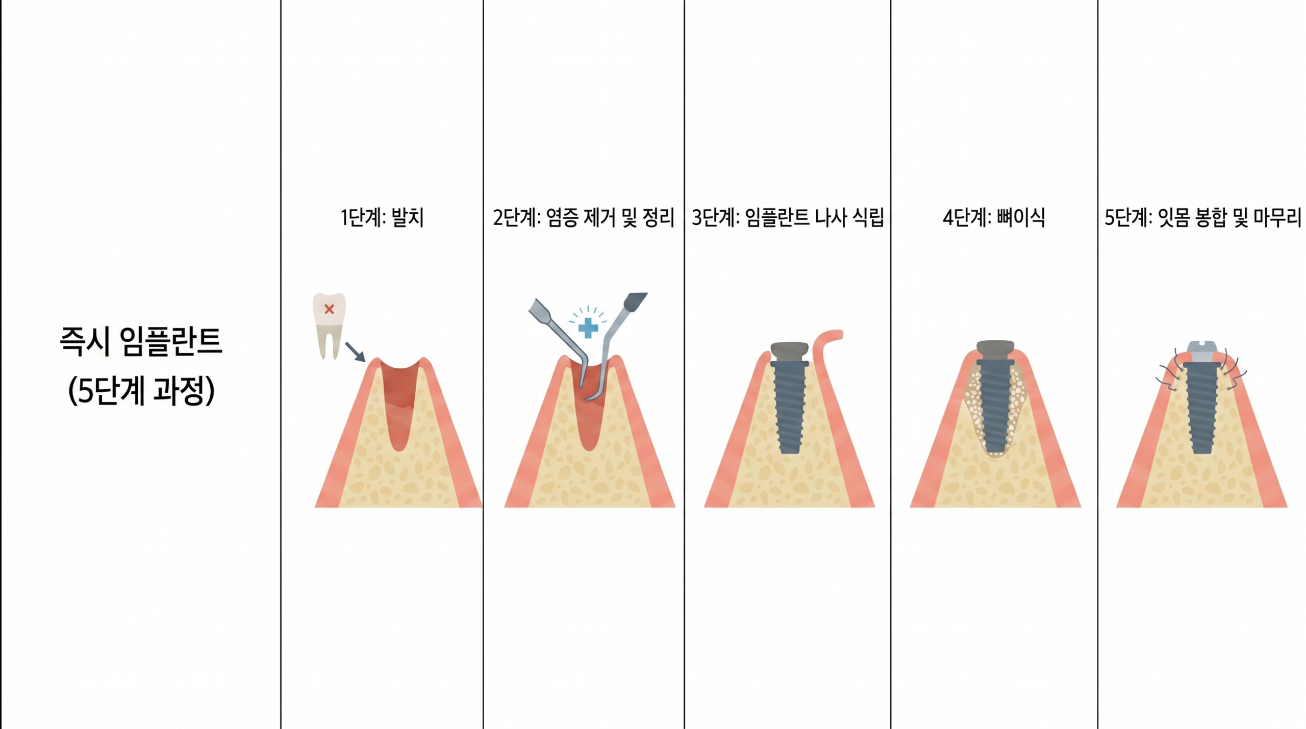 seoulinplant implant surgical procedure step by step