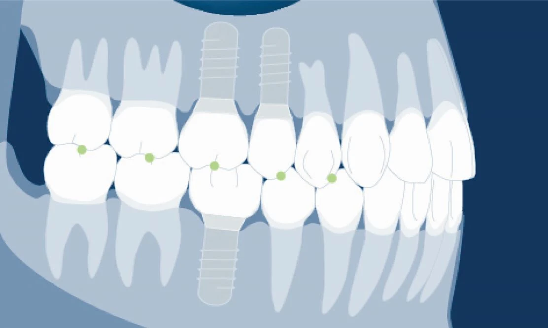 seoulinplant Occlusal Load Management