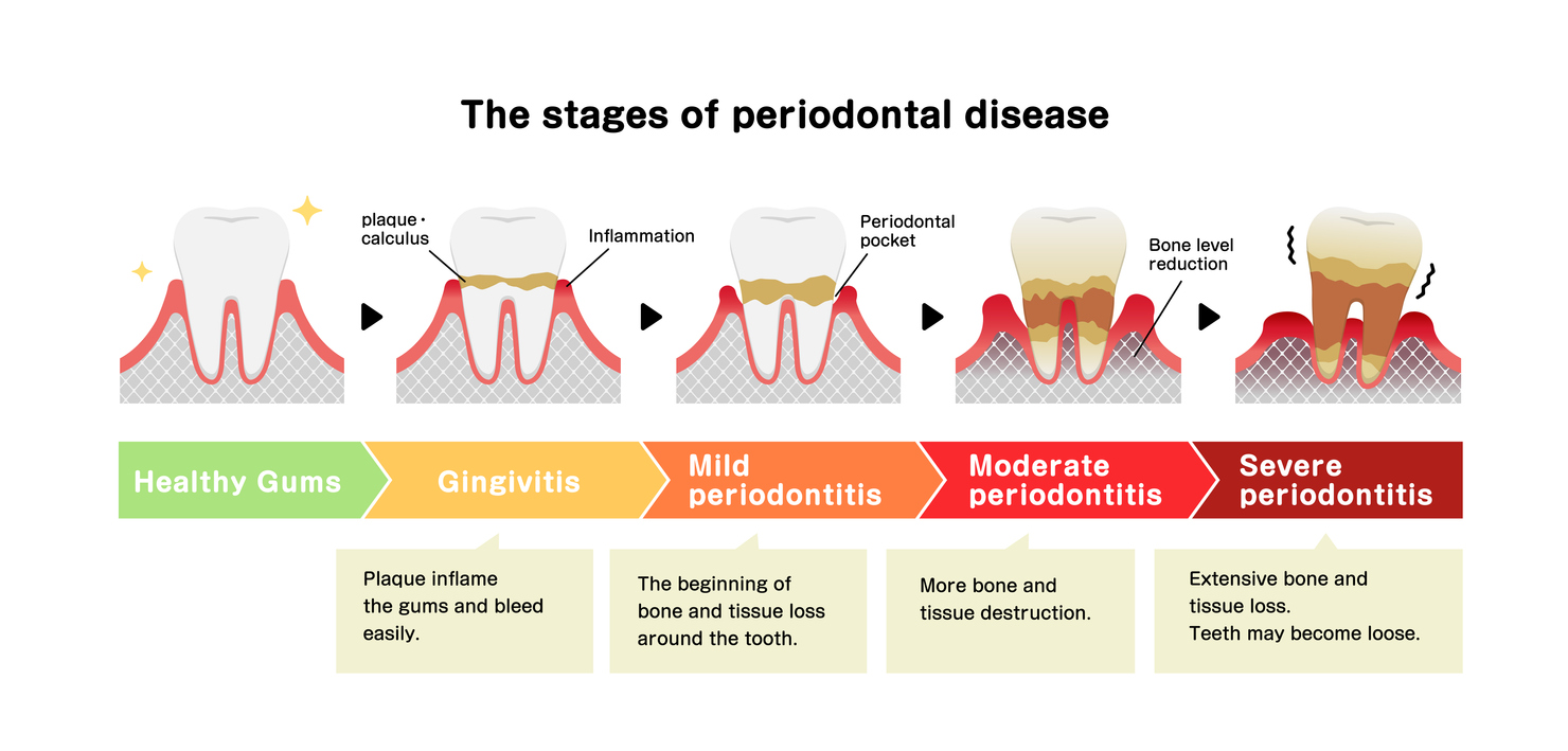 seoulinplant Periodontal Disease Stages