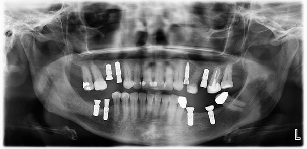 implant maintenance checkup 예시 사진