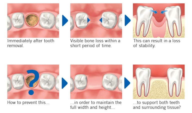seoulinplant bone resorption dental ridge preservation