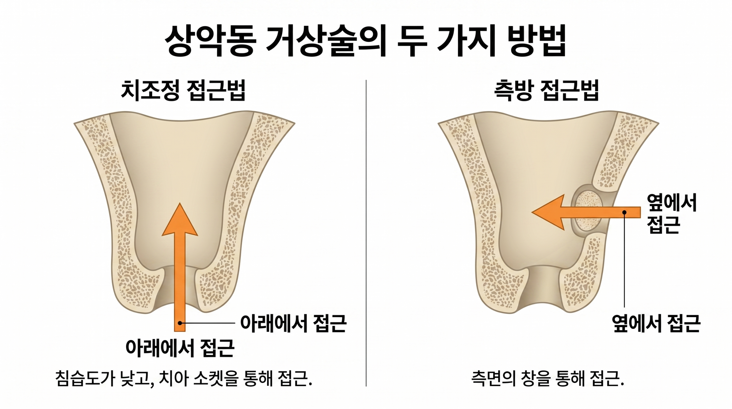 seoulinplant sinus lift lateral crestal approach comparison