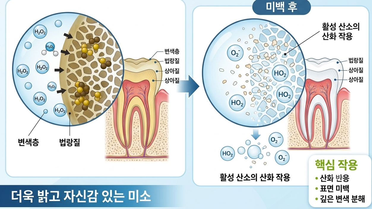 서울인플란트치과 치아미백 원리 설명 AI이미지