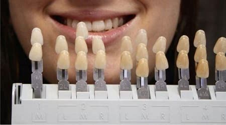 서울인플란트치과의원 색조 확인 예시 사진