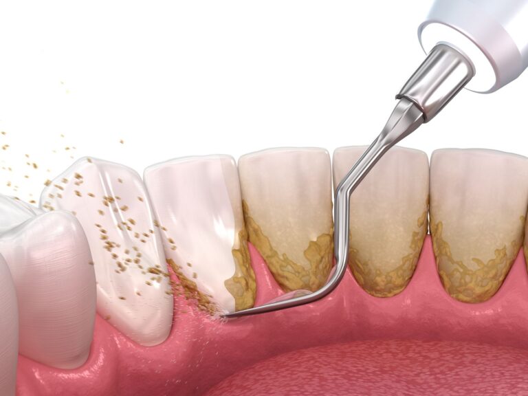 seoulinplant preventive dental care