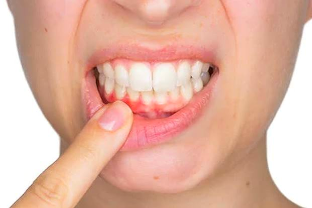 seoulinplant gum recession tooth mobility signs