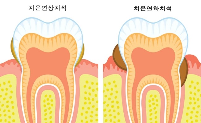 seoulinplant dental 치은연상치석과 치은연하치석